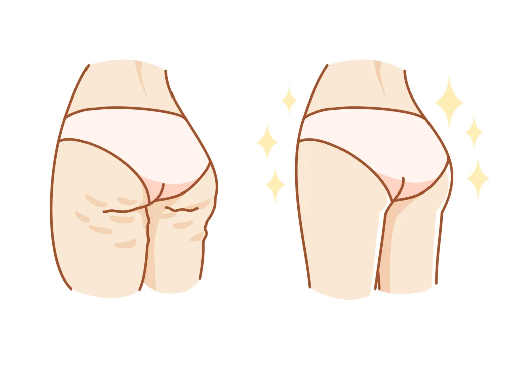 お尻トレーニングのビフォーアフター