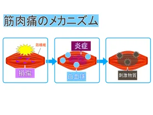 1102588 | 神楽坂のパーソナルジム|QUALITAS神楽坂店 筋肉痛のメカニズム